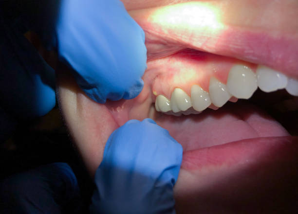 Best Dentist for Tooth Abscess  in Chicopee, MA